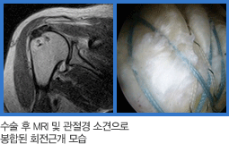 수술 후 MRI 및 관절경 소견으로 봉합된 회전근개 사진