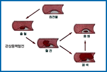 심혈관 촬영