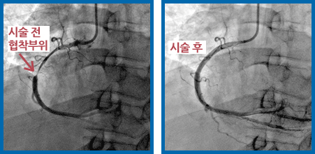 스텐트 삽입술 증례 관련 이미지