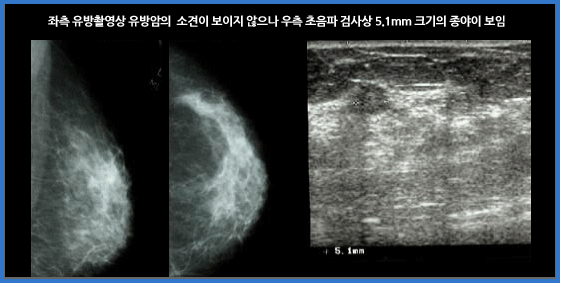 유방암 영상진단 이미지 두번째