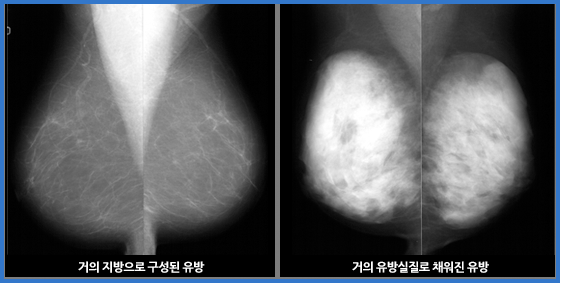 유방암초음파검사 이미지 두번째