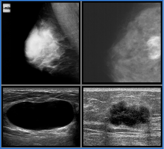 유방암초음파검사 이미지 세번째