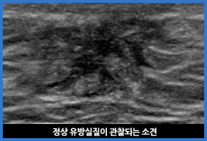 여성형 유방 관련 이미지