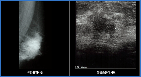 유방암 영상진단 이미지 첫번째