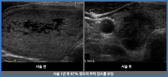 갑상선 고주파 절제술 관련 이미지 두번째