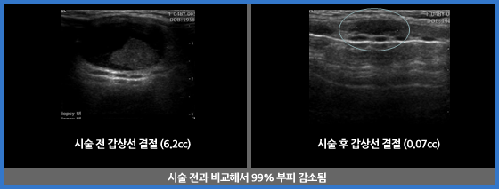 갑상선에탄올절제술 관련 이미지 첫번째