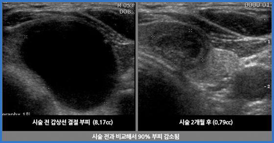 갑상선에탄올절제술 관련 이미지 두번째