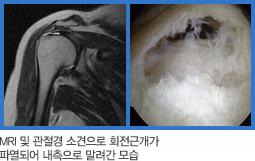 MRI 및 관절경 소견으로 회전근개가 파열되어 내측으로 말려간 사진