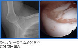 X-ray 및 관절경 소견상 뼈가 닳아 있는 사진