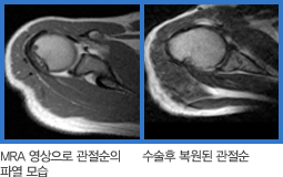 MRA 영상으로 관절순의 파열 사진, 수술후 복원된 관절순