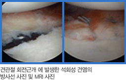 관절경 소견으로 관절순의 파열 모습, 수술 후 관절경 사진
