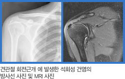 견관절 회전근개 에 발생한 석회성 건염의 방사선 사진 및 MRI 사진 