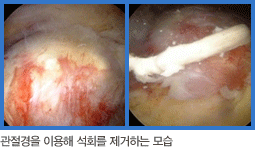 관절경을 이용해 석회를 제거하는 사진 