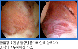 관절경 소견상 염증반응으로 인해 활액막이 
증식되고 두꺼워진 소견사진 