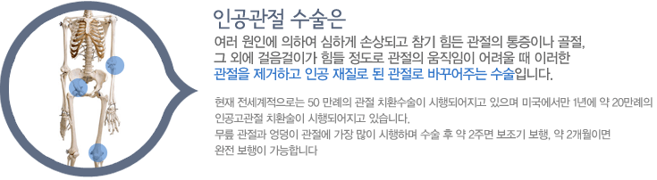 인공관절 수술은 여러 원인에 의하여 심하게 손상되고 참기 힘든 관절의 통증이나 골절, 그 외에 걸음걸이가 힘들 정도로 관절의 움직임이 어려울 때 이러한 관절을 제거하고 인공 재질로 된 관절로 바꾸어주는 수술입니다현재 전세계적으로는 50 만례의 관절 치환수술이 시행되어지고 있으며 미국에서만 1년에 약 20만례의 인공고관절 치환술이 시행되어지고 있습니다. 
무릎 관절과 엉덩이 관절에 가장 많이 시행하며 수술 후 약 2주면 보조기 보행, 약 2개월이면 완전 보행이 가능합니다.